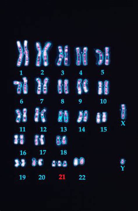sindrome de down cromossomo - como tomar captura de pantalla